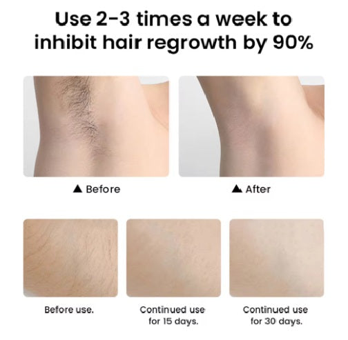 Epilator IPL Profesional 3 in 1 RIR® – Epilare Definitiva, Intinerirea Pielii si Tratarea Acneei, Gri Antracit